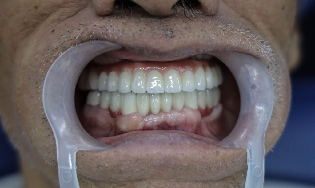 kết quả trồng răng toàn hàm của Chú N.V.H