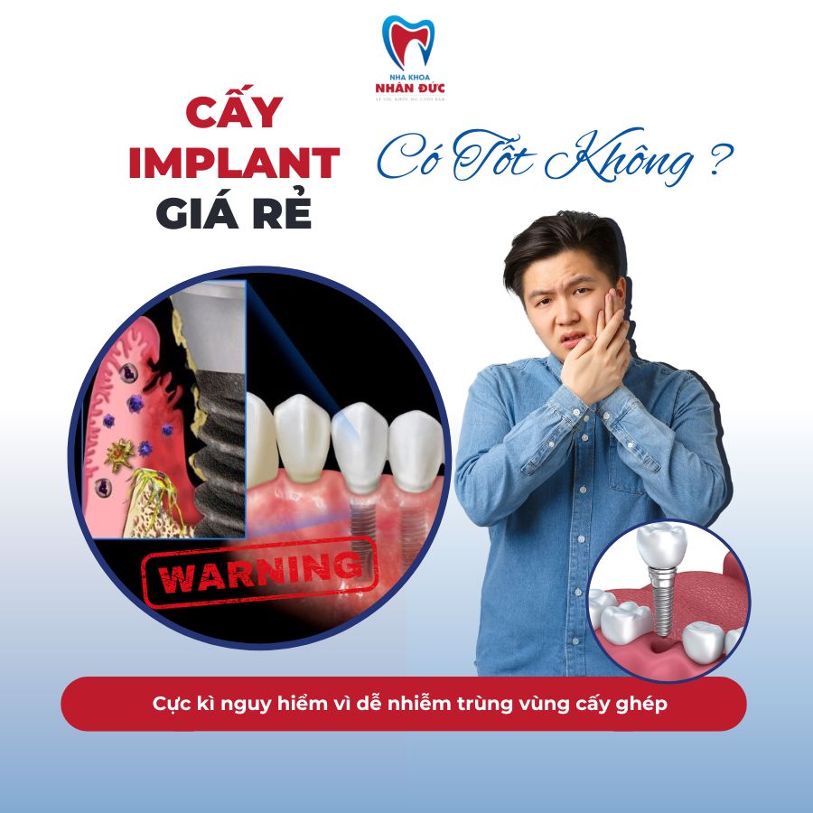cấy ghép implant giá rẻ có tốt không ?