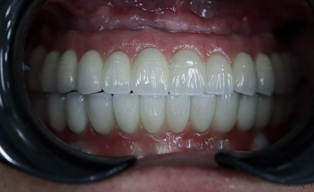kết quả trồng răng toàn hàm cho chú N.V.T