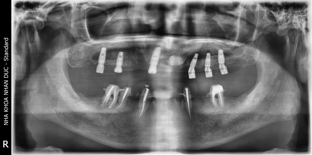 Chú N.V.H trồng răng implant toàn hàm trên