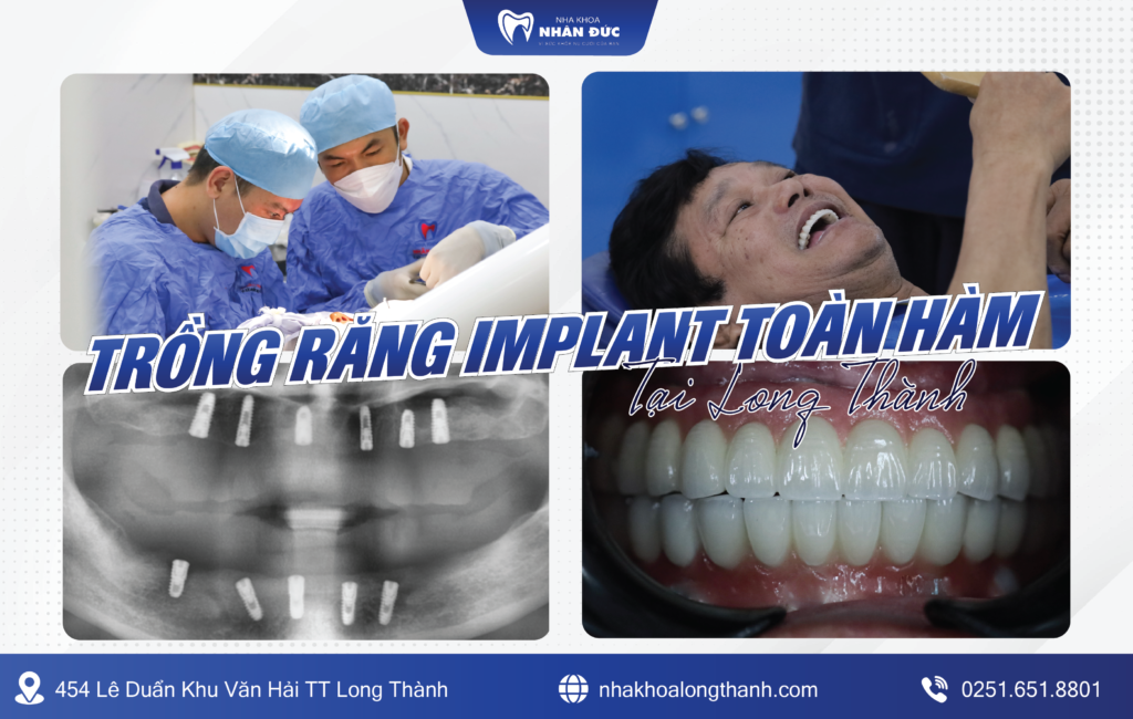 Trồng răng Implant toàn hàm tại Long Thành